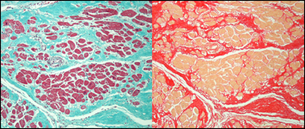 心筋線維の瘢痕組織の Masson-Trichrom と sirius red 染色
